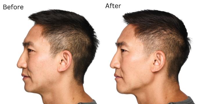 Before & After Voluma Case 214 View 1 View in Santa Rosa, California