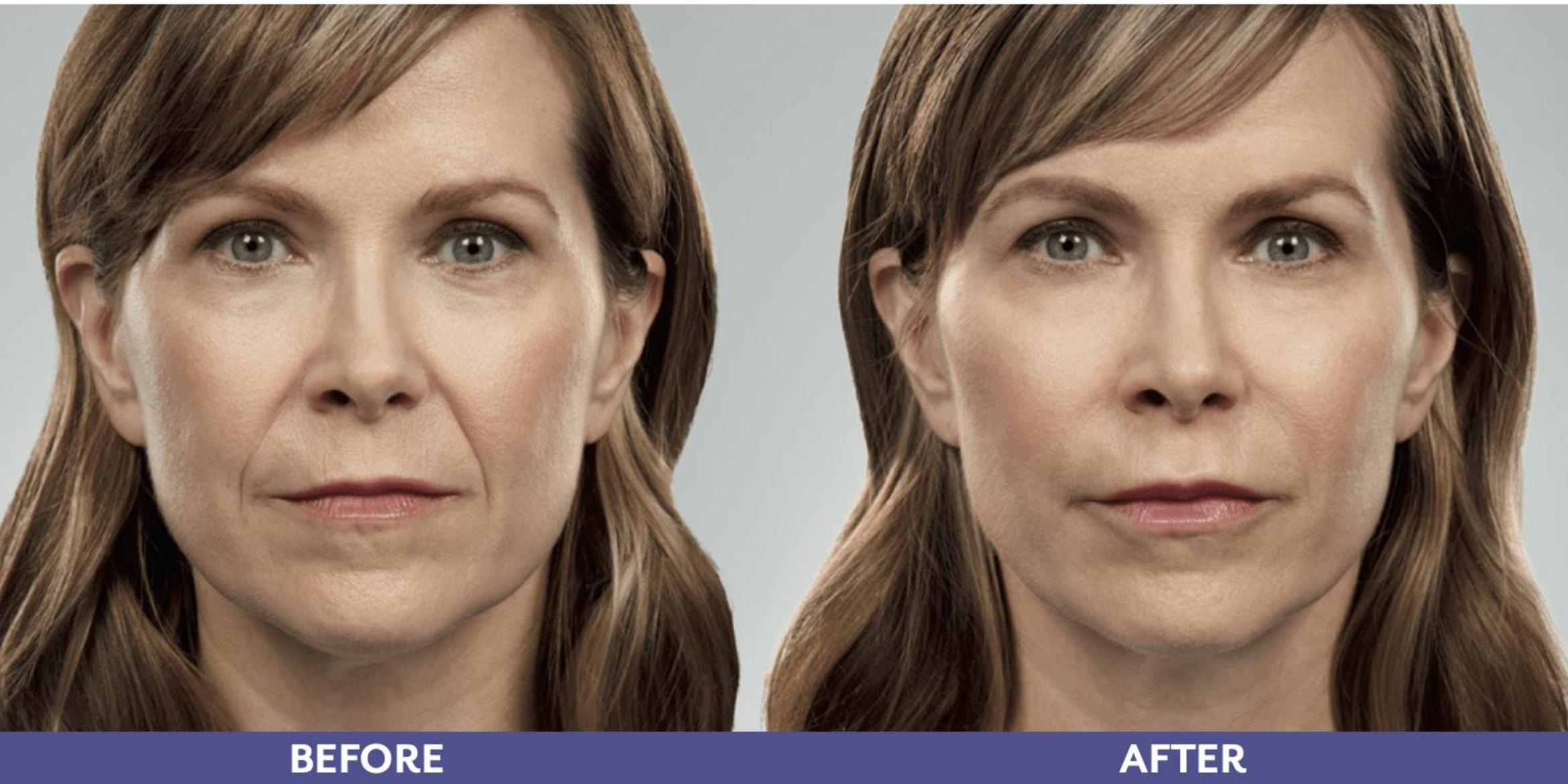 Before & After Voluma Case 215 View 1 View in Santa Rosa, California