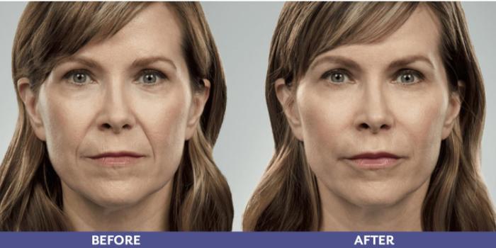 Before & After Voluma Case 215 View 1 View in Santa Rosa, California