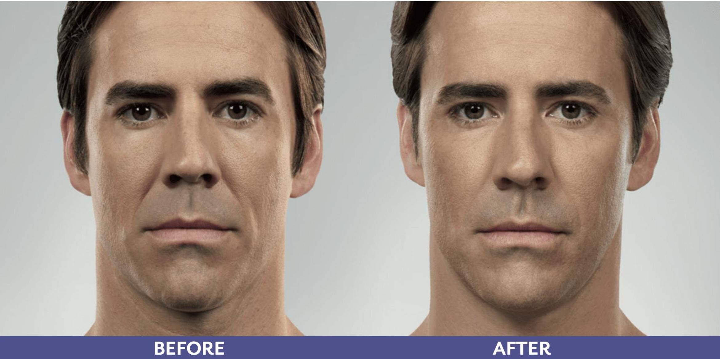 Before & After Voluma Case 216 View 1 View in Santa Rosa, California