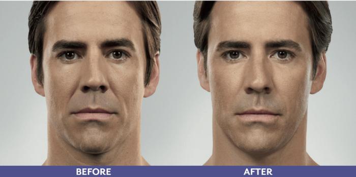 Before & After Voluma Case 216 View 1 View in Santa Rosa, California