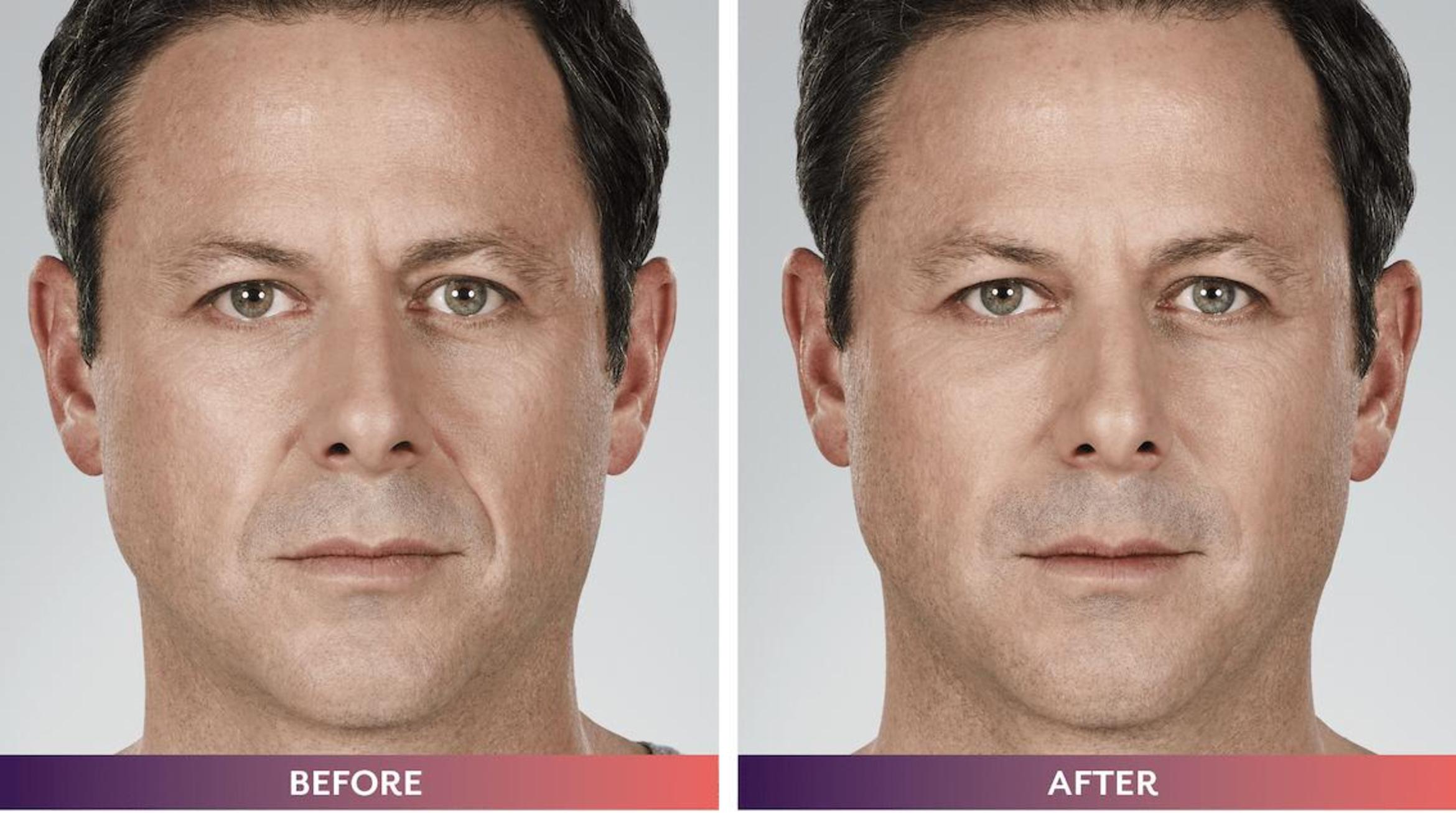 Before & After Voluma Case 217 View 1 View in Santa Rosa, California