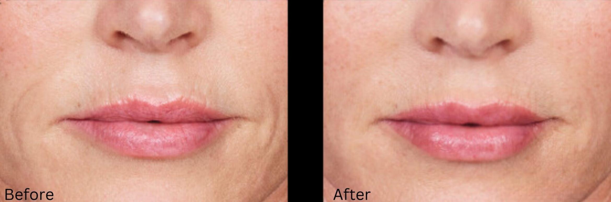 Before & After Voluma Case 331 View 1 View in Santa Rosa, California