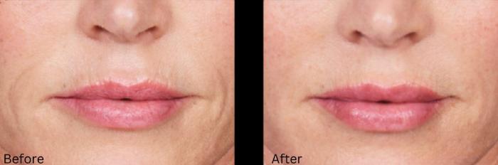 Before & After Voluma Case 331 View 1 View in Santa Rosa, California