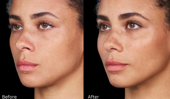 Before & After Voluma Case 332 View 1 View in Santa Rosa, California