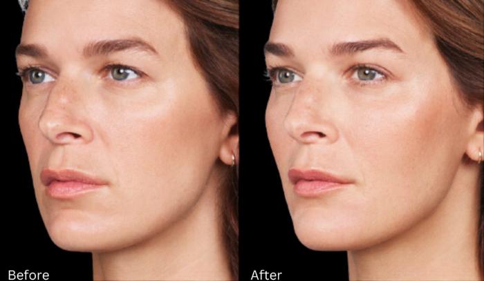 Before & After Voluma Case 333 View 1 View in Santa Rosa, California