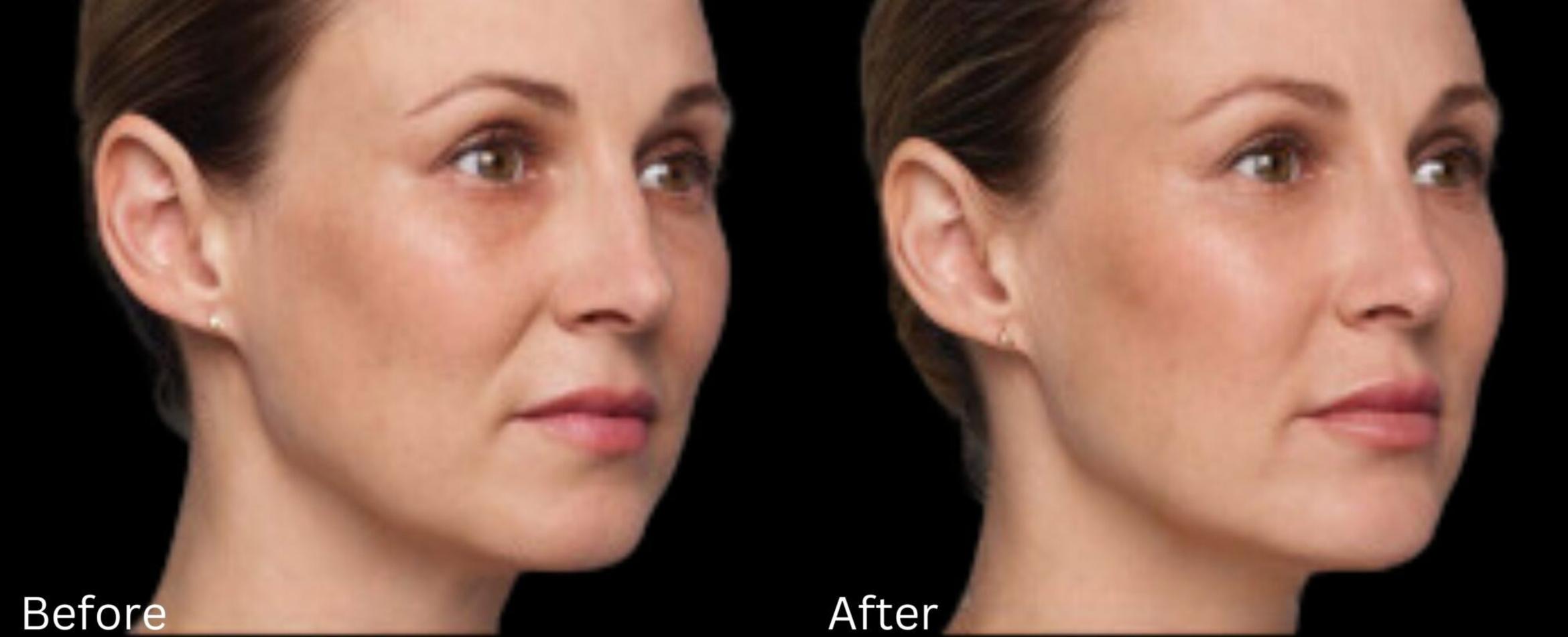 Before & After Voluma Case 334 View 1 View in Santa Rosa, California