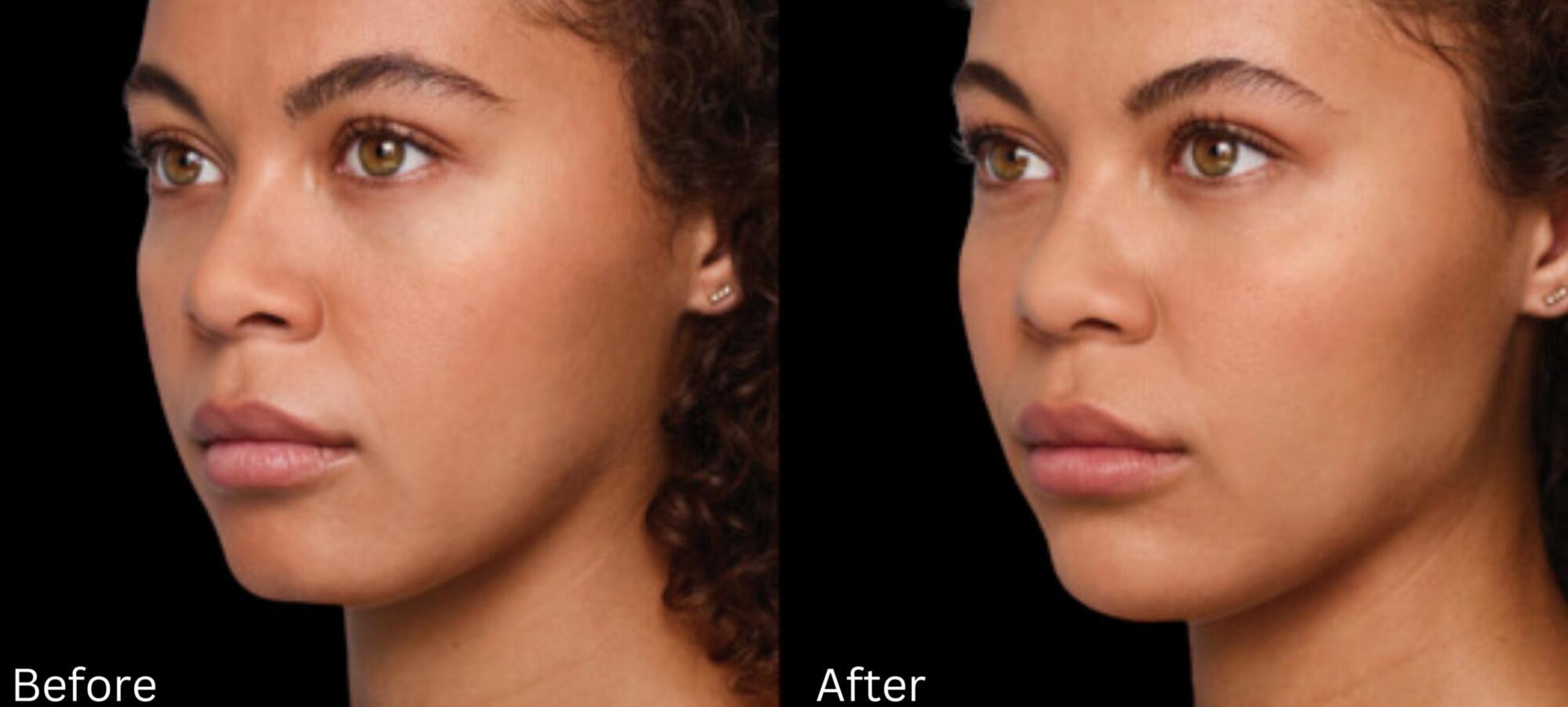 Before & After Voluma Case 335 View 1 View in Santa Rosa, California