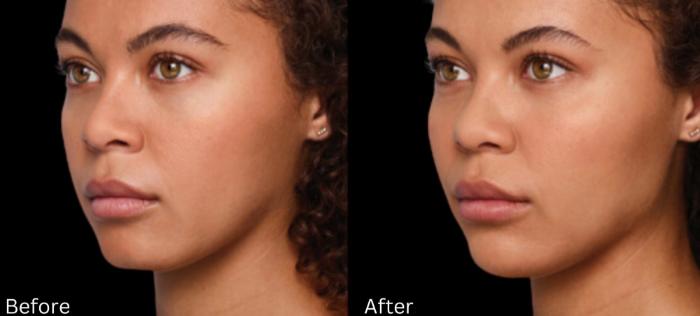 Before & After Voluma Case 335 View 1 View in Santa Rosa, California