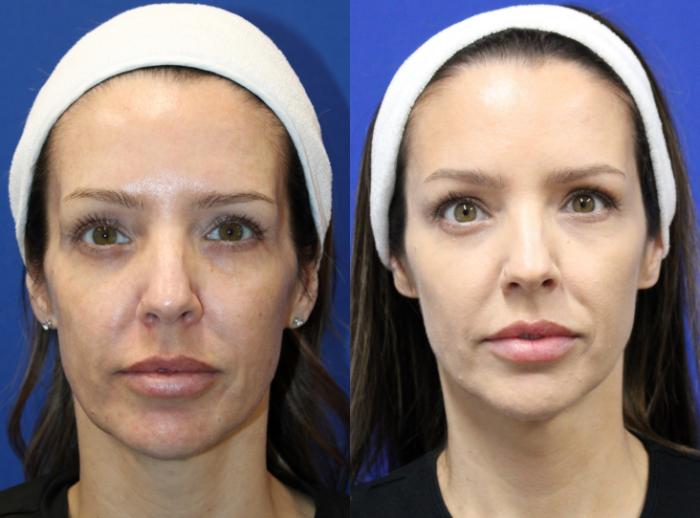 Before & After Voluma Case 431 Front View in Santa Rosa, California