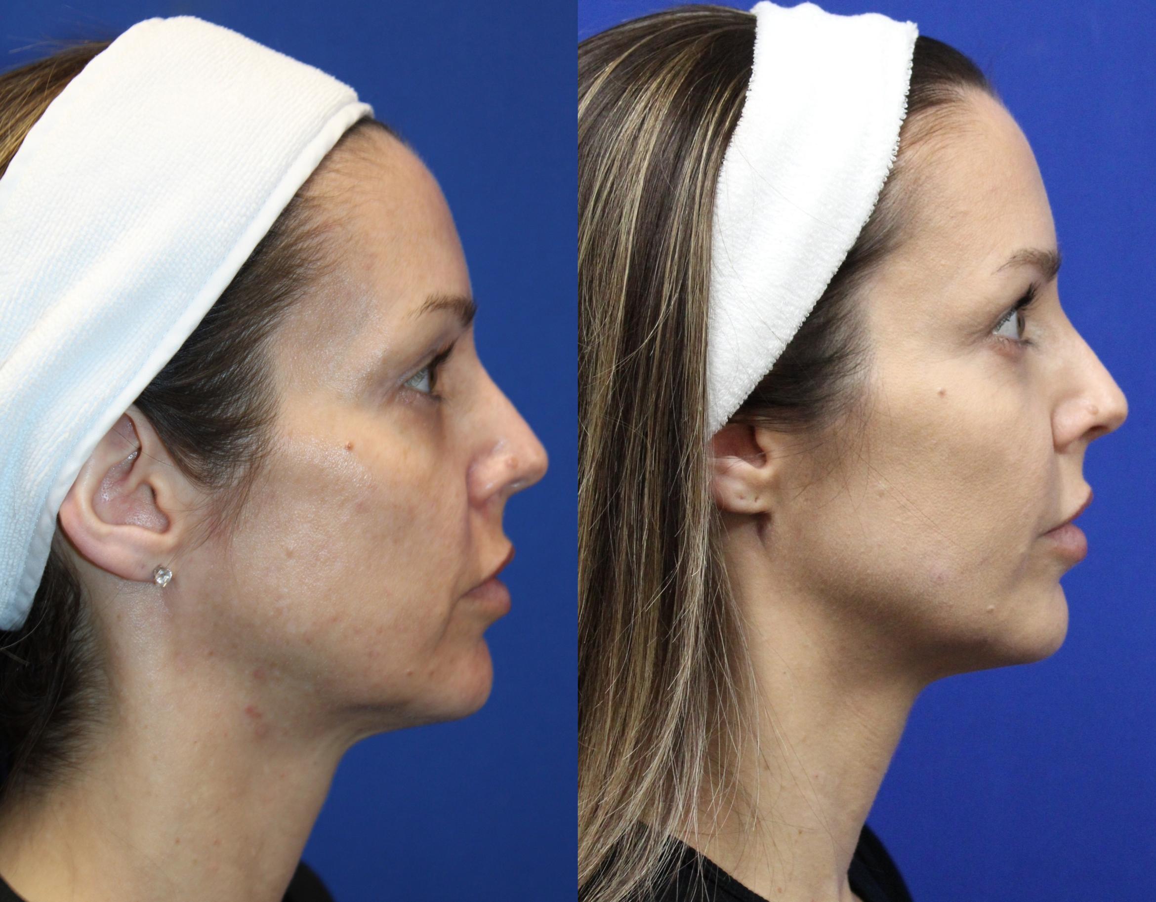 Before & After Voluma Case 431 Left Oblique View in Santa Rosa, California