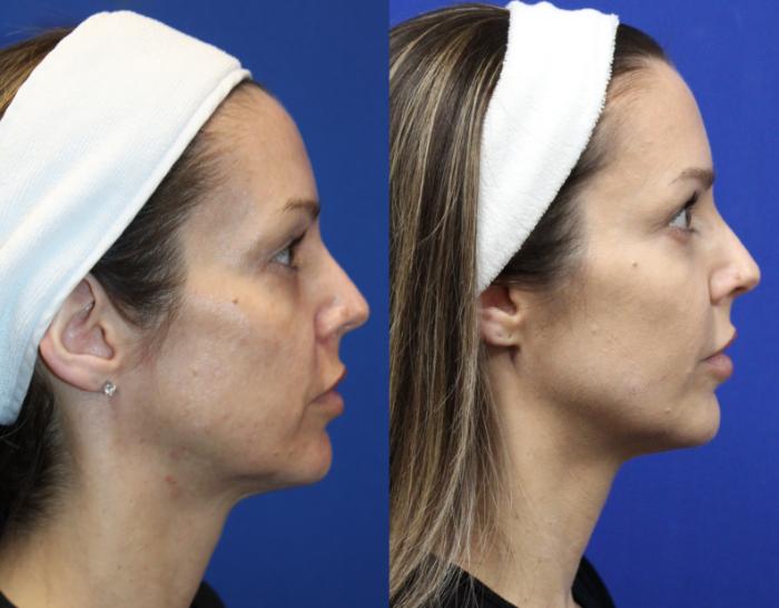 Before & After Voluma Case 431 Left Oblique View in Santa Rosa, California