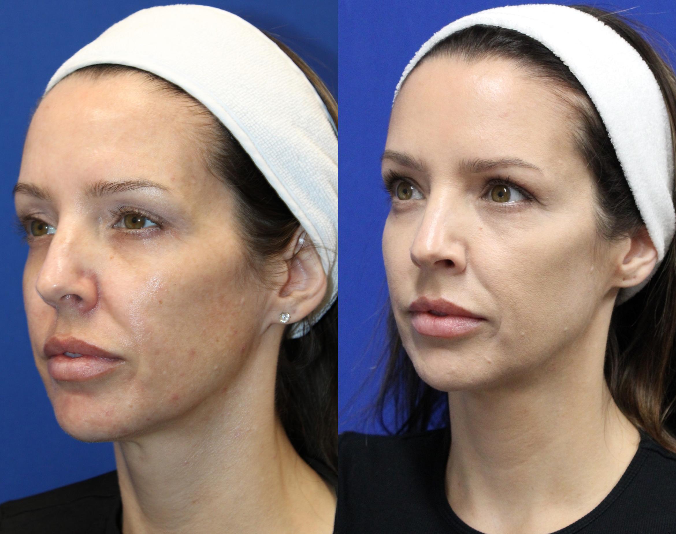 Before & After Voluma Case 431 Left Side View in Santa Rosa, California