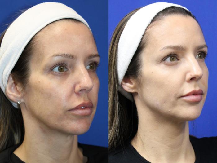 Before & After Voluma Case 431 Right Oblique View in Santa Rosa, California