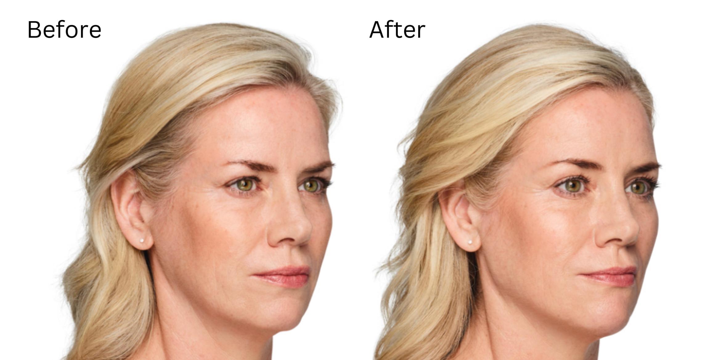Before & After Volux Case 222 View 1 View in Santa Rosa, California