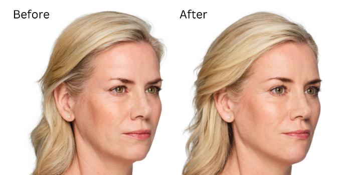 Before & After Volux Case 222 View 1 View in Santa Rosa, California