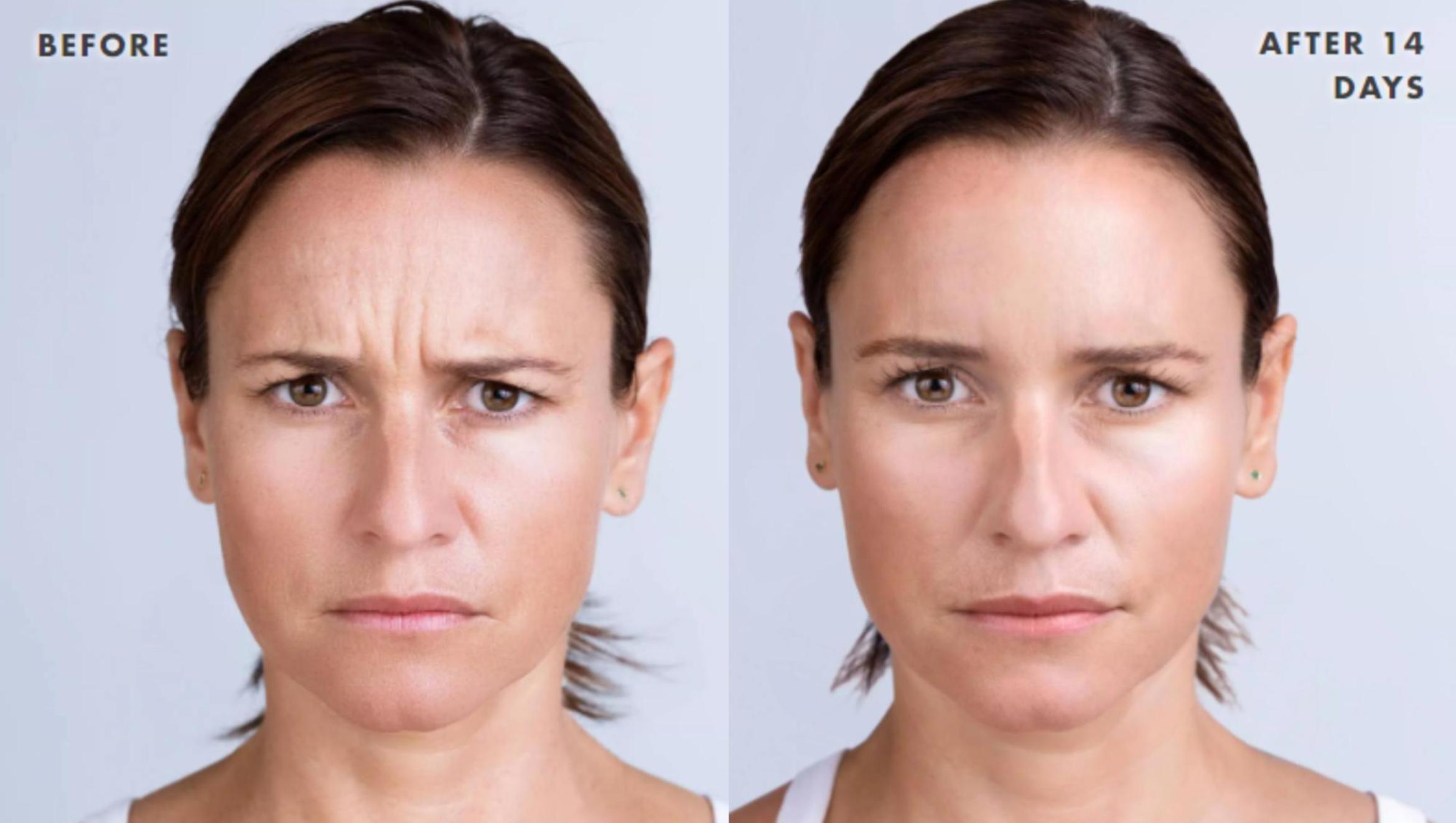 Before & After Xeomin Case 218 View 1 View in Santa Rosa, California