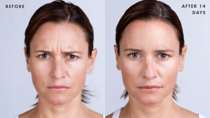 Before & After Xeomin Case 218 View 1 View in Santa Rosa, California