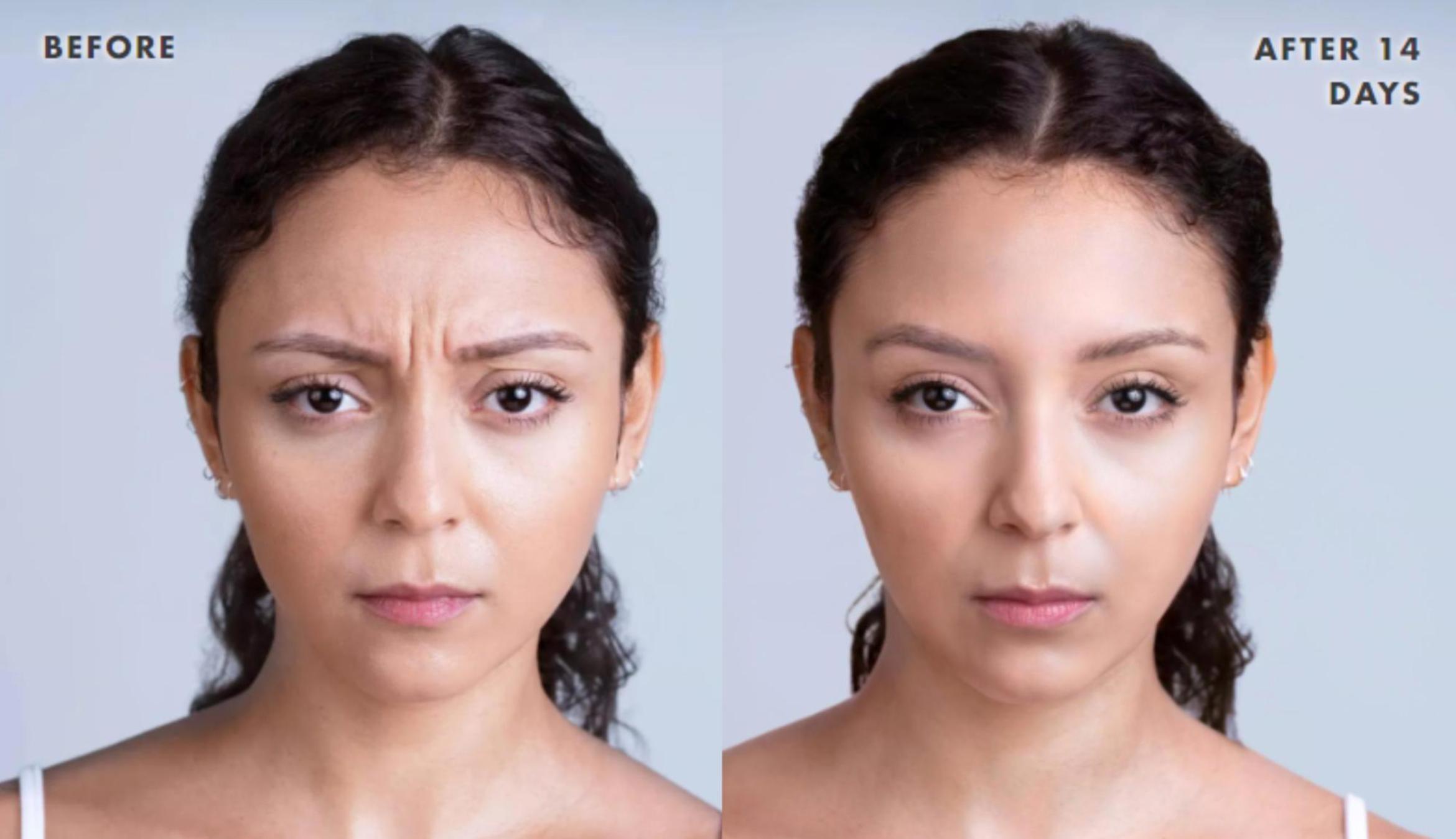 Before & After Xeomin Case 219 View 1 View in Santa Rosa, California