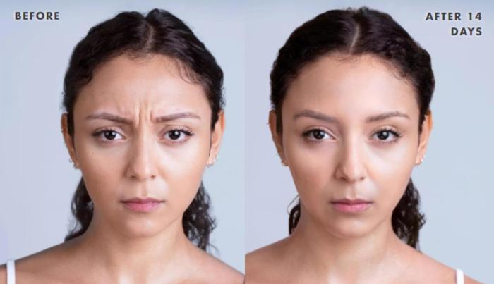 Before & After Xeomin Case 219 View 1 View in Santa Rosa, California