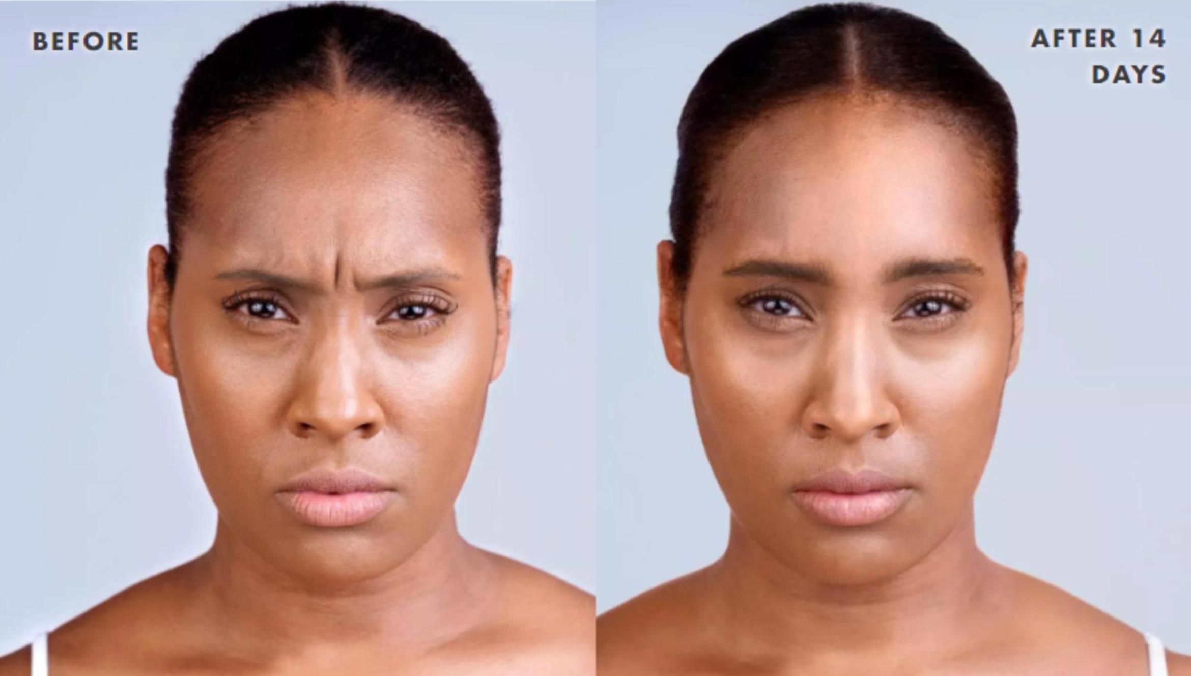 Before & After Xeomin Case 220 View 1 View in Santa Rosa, California
