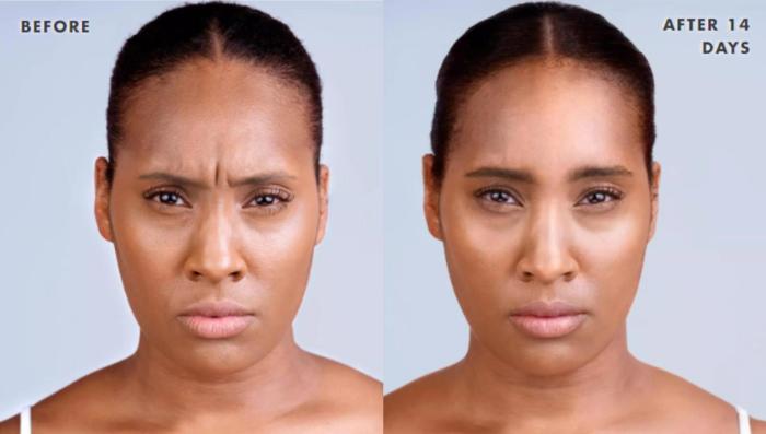 Before & After Xeomin Case 220 View 1 View in Santa Rosa, California