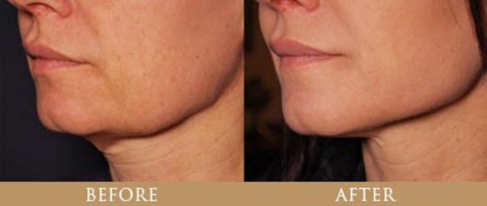Before & After Y Lift Instant Facelift Case 127 View 1 View in Santa Rosa, California