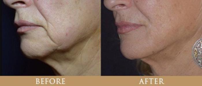 Before & After Y Lift Instant Facelift Case 128 View 1 View in Santa Rosa, California