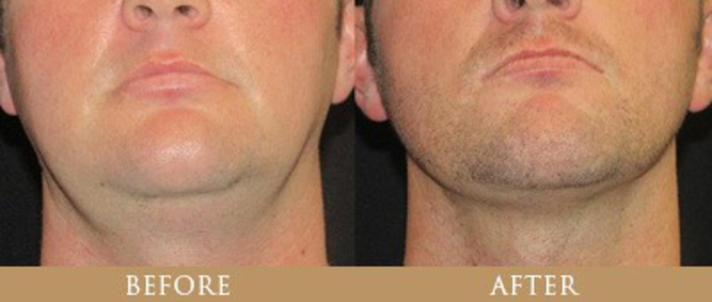 Before & After Y Lift Instant Facelift Case 129 View 1 View in Santa Rosa, California