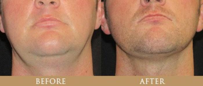 Before & After Y Lift Instant Facelift Case 129 View 1 View in Santa Rosa, California