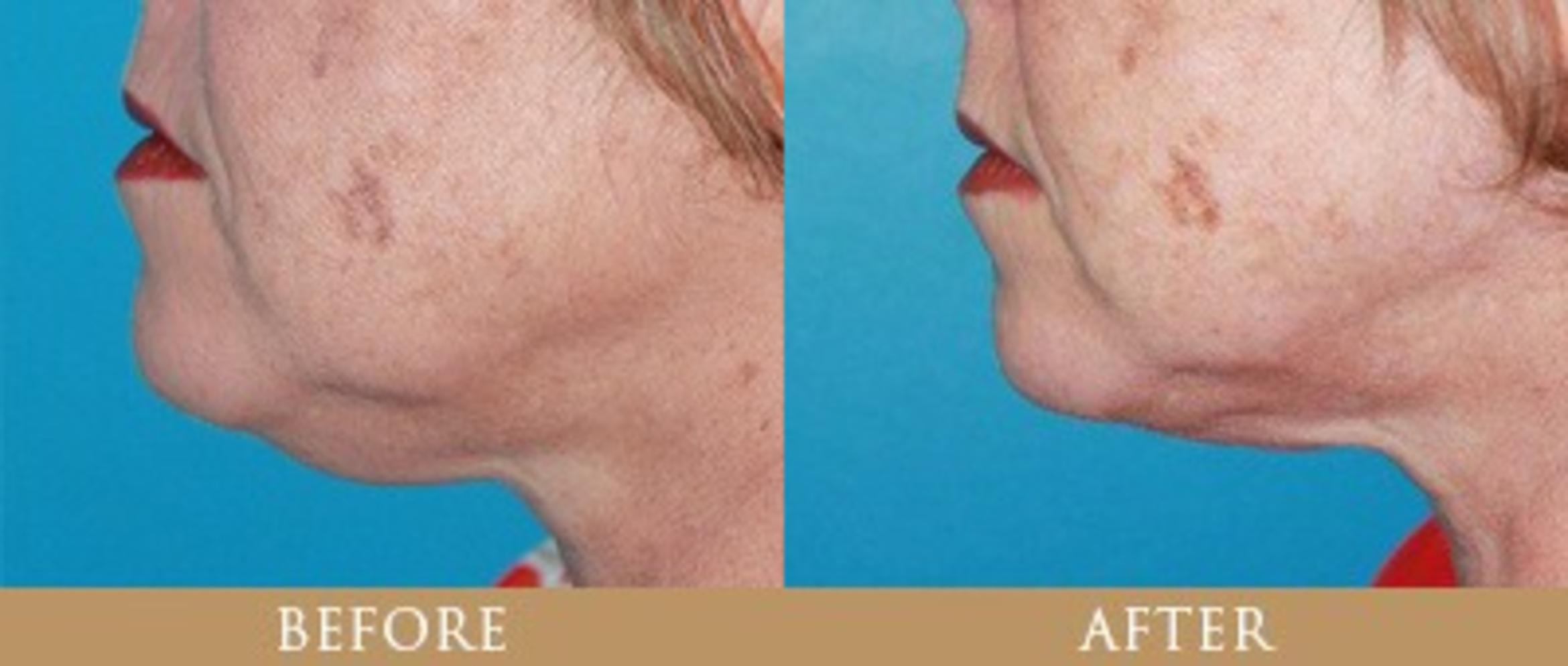 Before & After Y Lift Instant Facelift Case 130 View 1 View in Santa Rosa, California