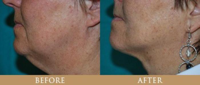 Before & After Y Lift Instant Facelift Case 131 View 1 View in Santa Rosa, California