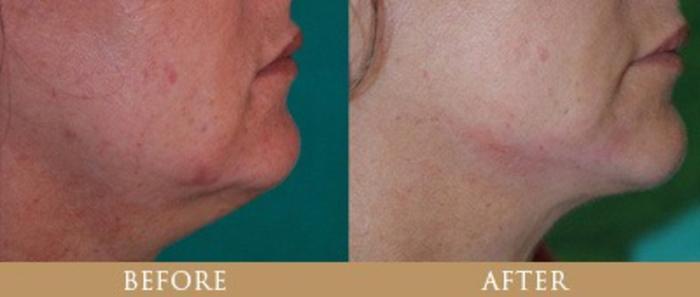 Before & After Y Lift Instant Facelift Case 132 View 1 View in Santa Rosa, California
