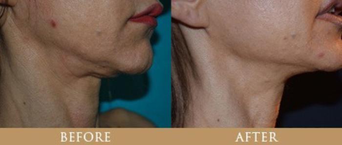 Before & After Y Lift Instant Facelift Case 133 View 1 View in Santa Rosa, California