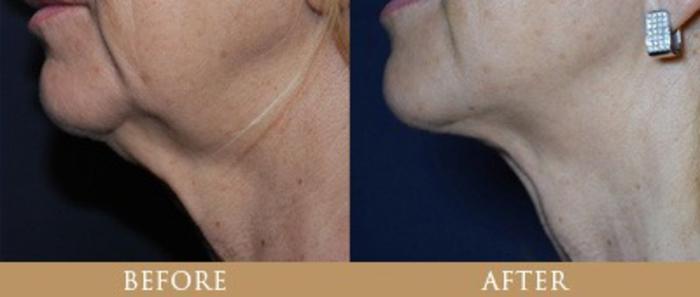 Before & After Y Lift Instant Facelift Case 134 View 1 View in Santa Rosa, California