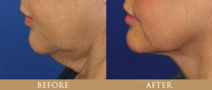 Before & After Y Lift Instant Facelift Case 135 View 1 View in Santa Rosa, California