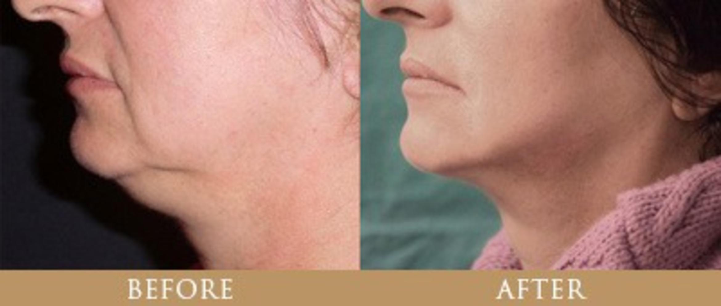 Before & After Y Lift Instant Facelift Case 136 View 1 View in Santa Rosa, California
