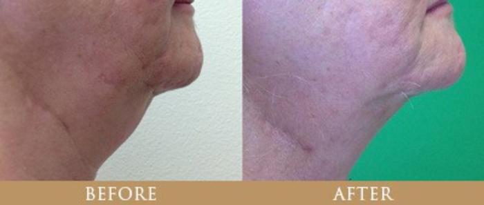 Before & After Y Lift Instant Facelift Case 137 View 1 View in Santa Rosa, California