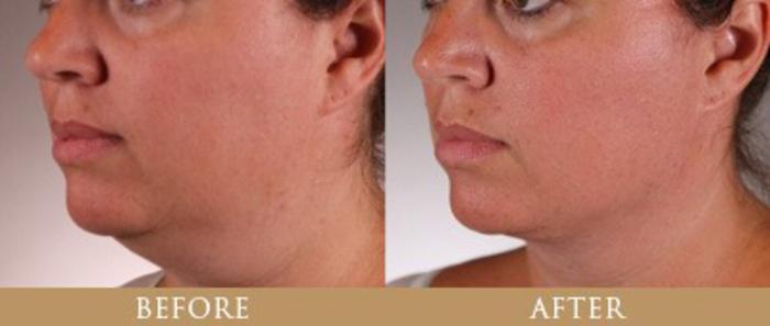Before & After Y Lift Instant Facelift Case 138 View 1 View in Santa Rosa, California