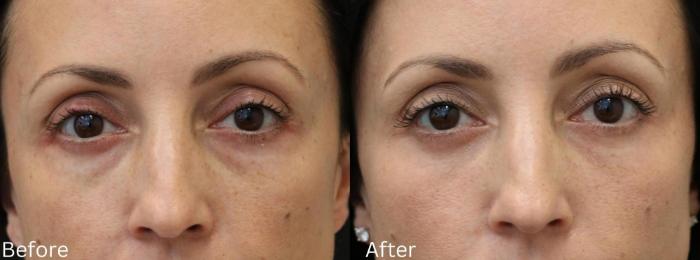 Before & After Y Lift Instant Facelift Case 148 View 1 View in Santa Rosa, California