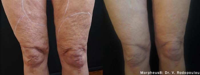 Before & After Y Lift Instant Facelift Case 149 View 1 View in Santa Rosa, California