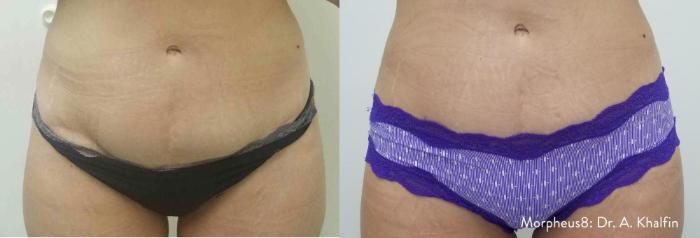 Before & After Y Lift Instant Facelift Case 150 View 1 View in Santa Rosa, California