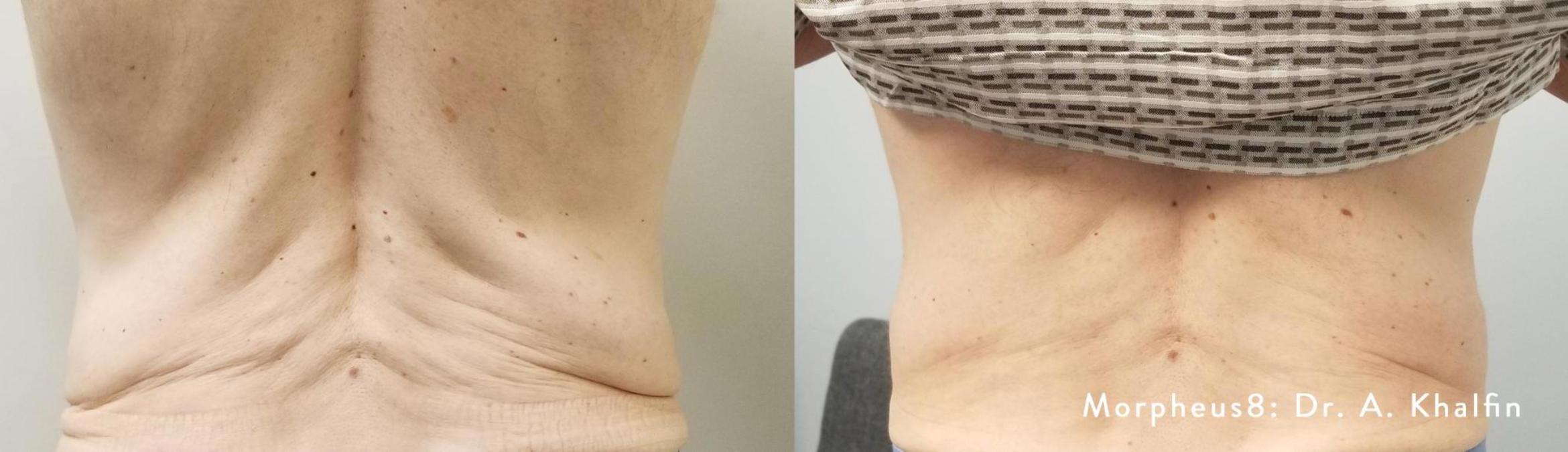 Before & After Y Lift Instant Facelift Case 151 View 1 View in Santa Rosa, California