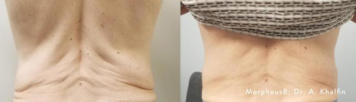 Before & After Y Lift Instant Facelift Case 151 View 1 View in Santa Rosa, California