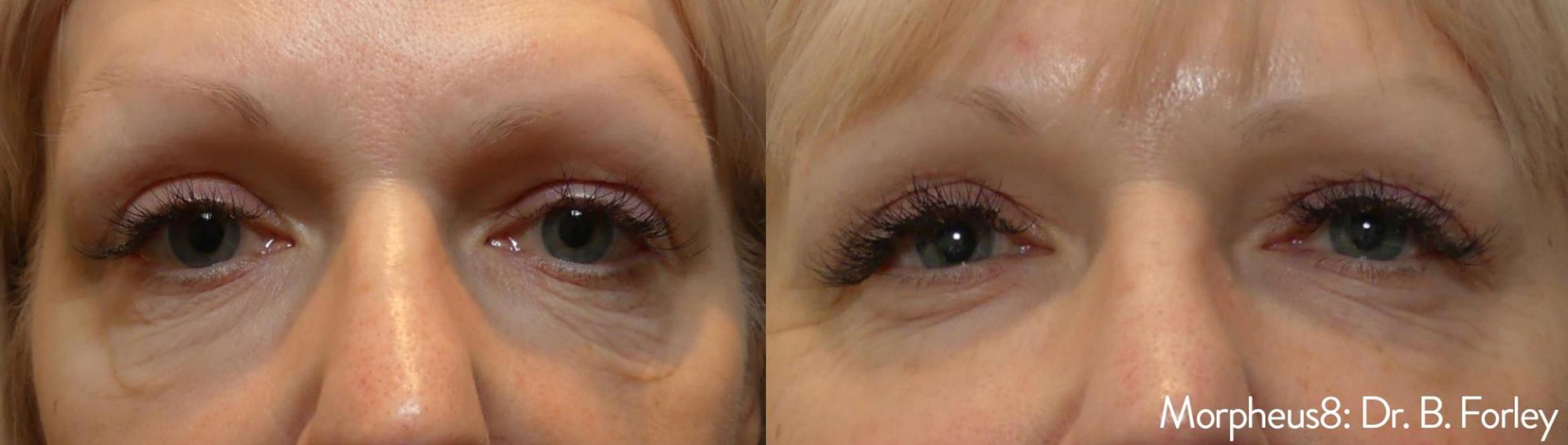 Before & After Y Lift Instant Facelift Case 152 View 1 View in Santa Rosa, California