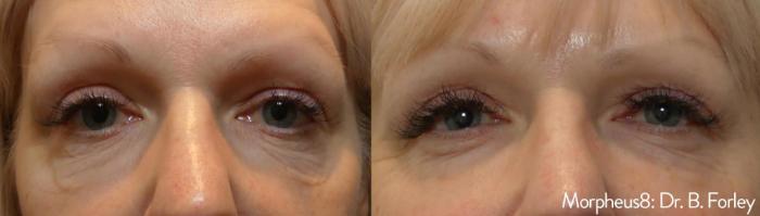 Before & After Y Lift Instant Facelift Case 152 View 1 View in Santa Rosa, California