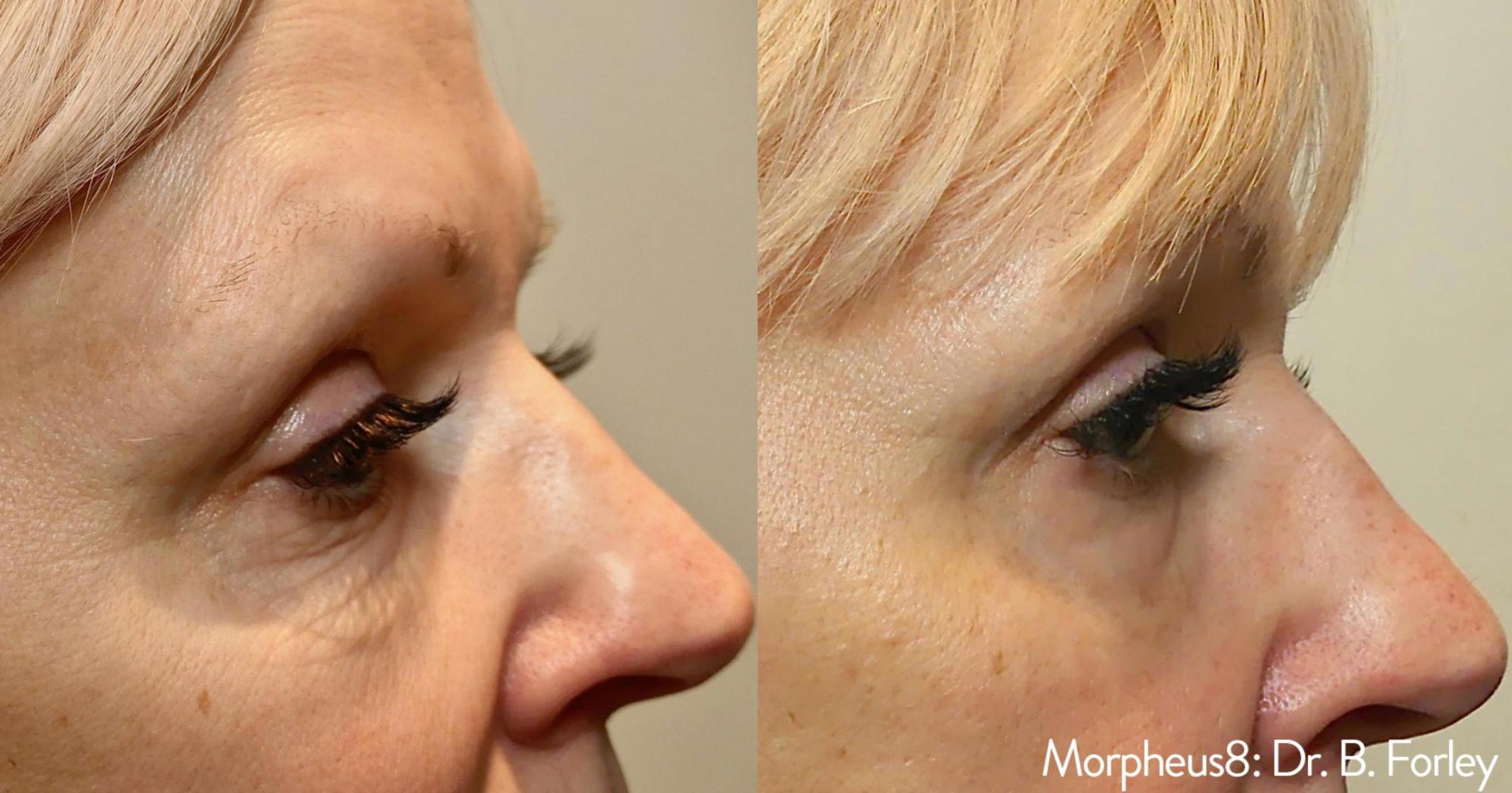 Before & After Y Lift Instant Facelift Case 152 View 2 View in Santa Rosa, California