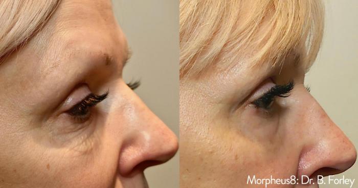 Before & After Y Lift Instant Facelift Case 152 View 2 View in Santa Rosa, California