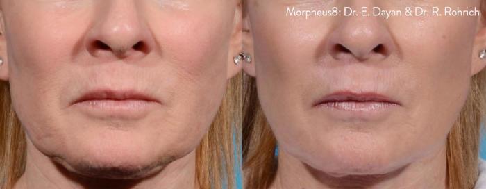Before & After Y Lift Instant Facelift Case 153 View 1 View in Santa Rosa, California