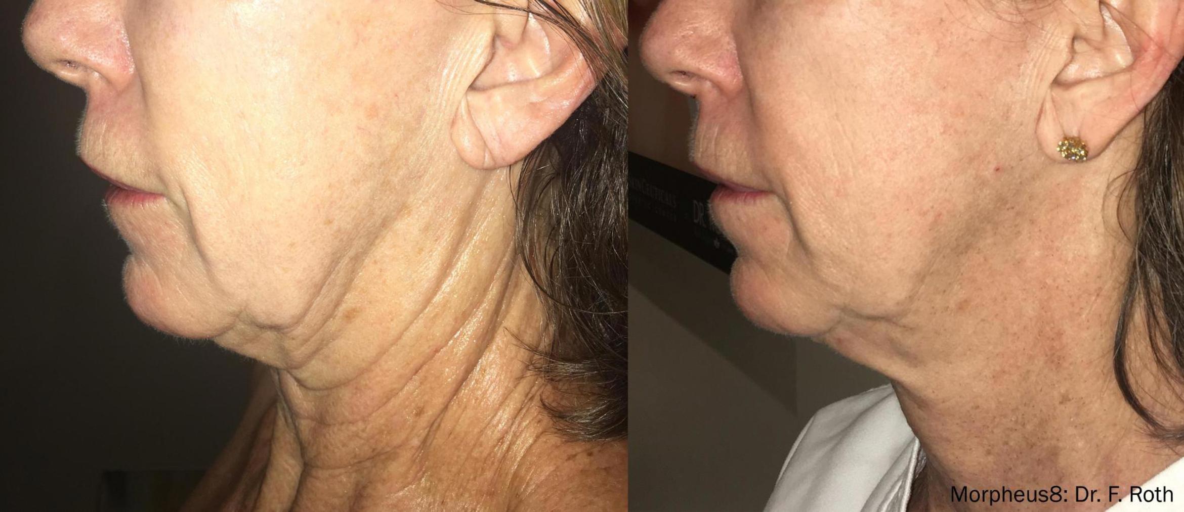 Before & After Y Lift Instant Facelift Case 154 View 1 View in Santa Rosa, California
